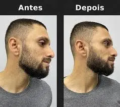 “Homem antes e depois do EnvyHair, com barba mais preenchida e cabelo fortalecido.”